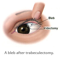 A bleb after trabeculectomy.)