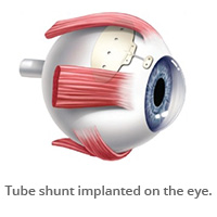 Tube shunt implanted on the eye.)